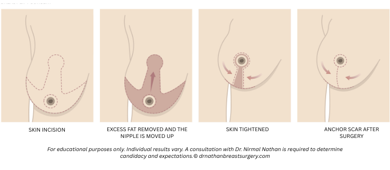 Illustration of the breast reduction surgery process using the anchor technique, showing skin incision, fat removal, nipple repositioning, skin tightening, and resulting scar pattern
